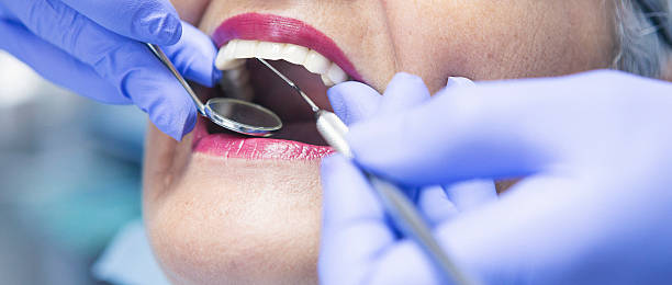 Best Emergency Wisdom Tooth Extraction in San Juan Pistrano, CA